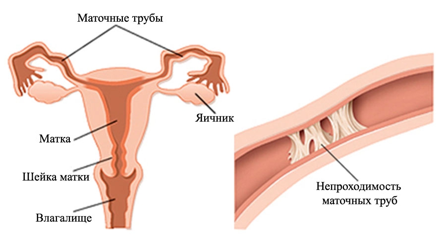 УЗИ маточных труб