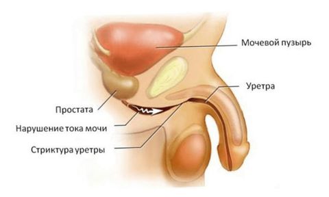 бужирование уретры