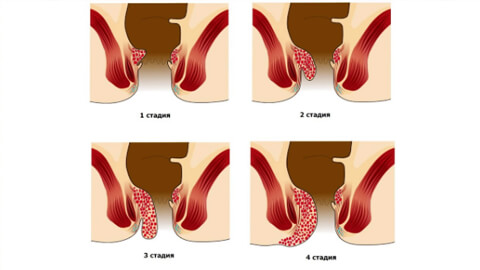Геморроидэктомия: что это такое, виды и рекомендации по реабилитации