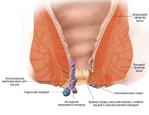 Тромбэктомия геморроидального узла