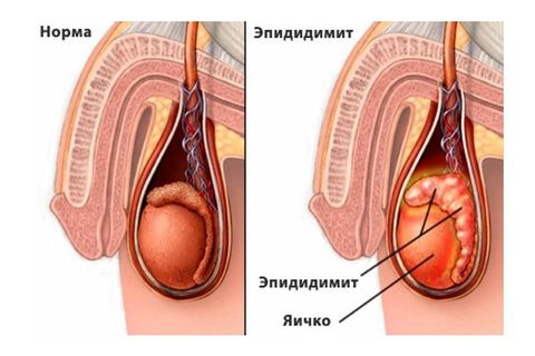 эпидидимит
