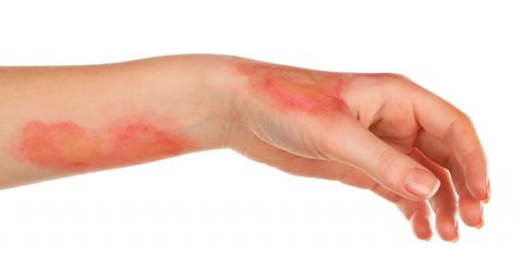Что может вызвать ожог кожи лечение thumbnail