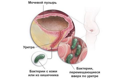 мочеполовые инфекции