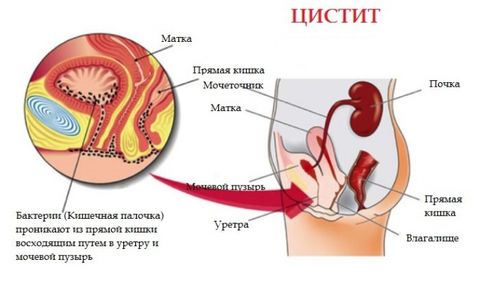 мочеполовые инфекции