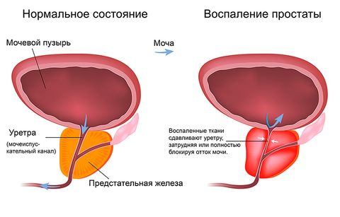 Инфекции мочевыводящих путей простатит thumbnail