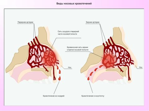 Носовое кровотечение анемия лечение thumbnail