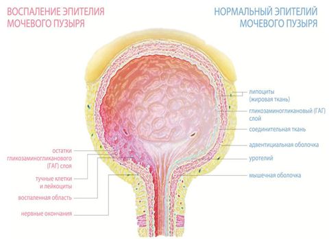 воспаление мочевого пузыря