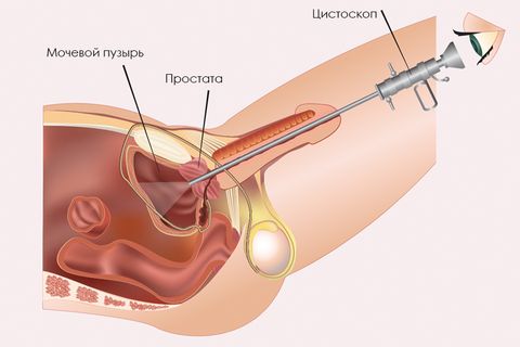 Мочевой пузырь воспаление у мужчин фото thumbnail