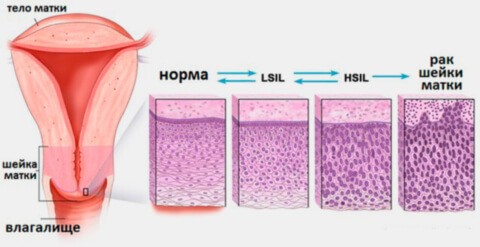 Дисплазия шейки матки