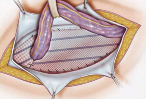 Грыжесечение (герниопластика)