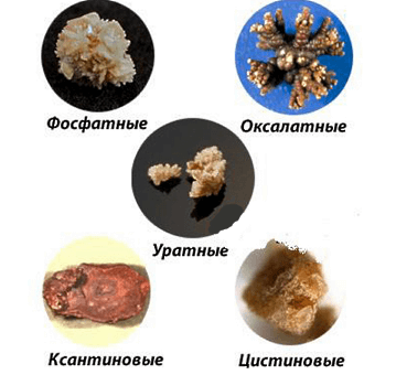 Камни в почках