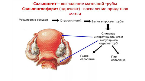 Сальпингоофорит Аднексит