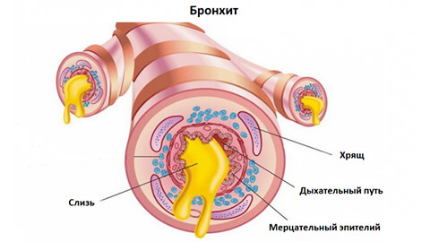 Как долго лечится бронхит? thumbnail