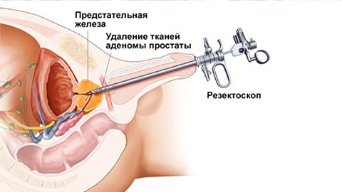 Хронический простатит