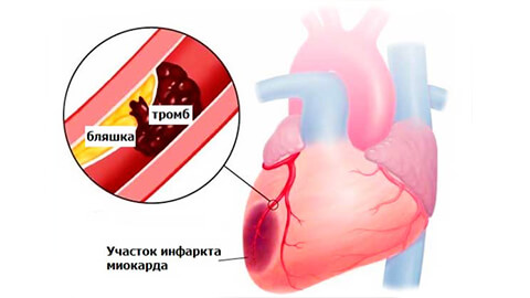 лечение инфаркта