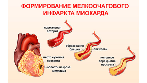 лечение инфаркта