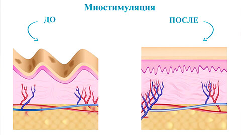 Миостимуляция