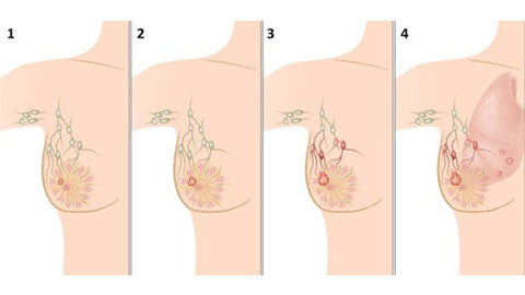Как вылечить опухоль груди thumbnail