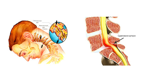 Шейный остеохондроз
