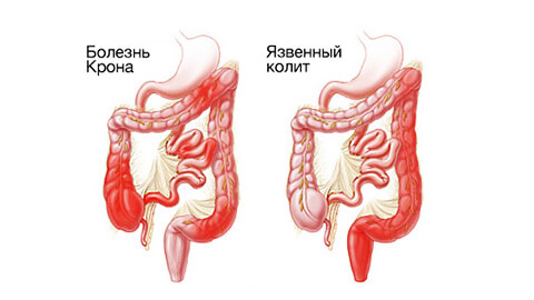 Язвенный колит кишечника