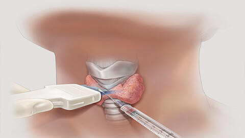 биопсия щитовидки