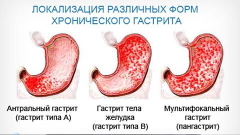 Признаки обострения гастрита желудка симптомы thumbnail