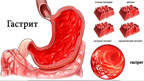 Гастрит желудка симптомы признаки thumbnail