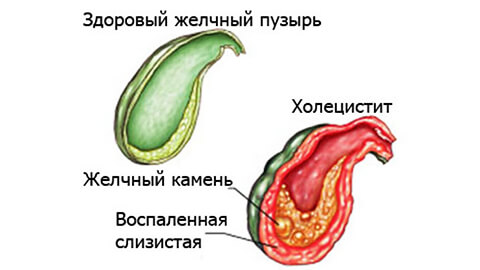 холецистит