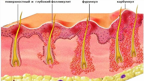 Лечение карбункулов домашних условиях thumbnail