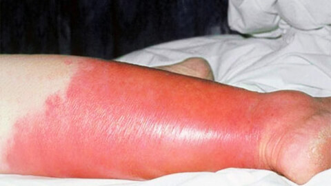 Рожистое воспаление ноги симптомы фото thumbnail