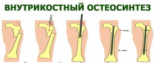 Остеосинтез