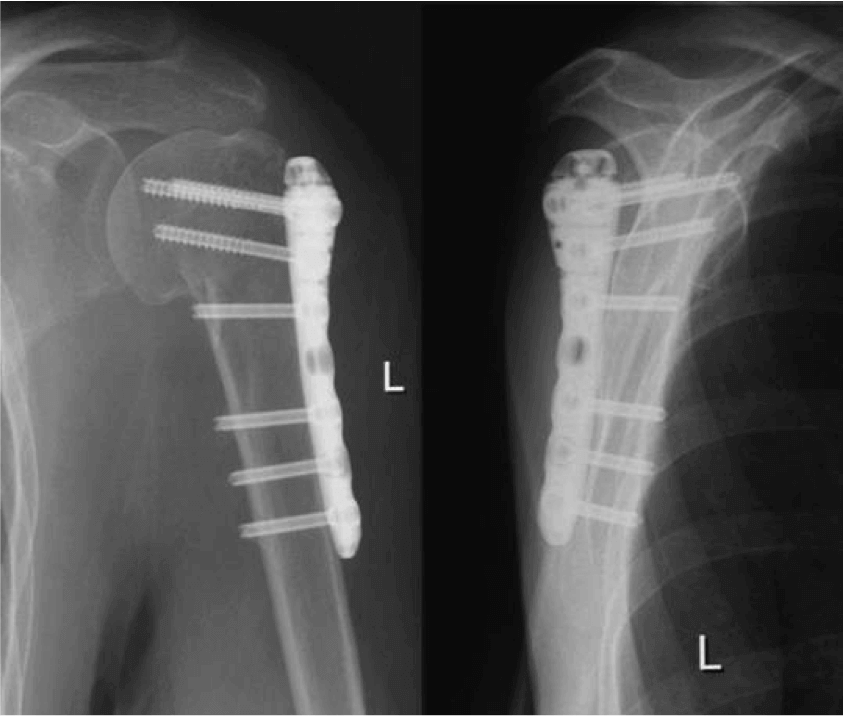 Операция после перелома плеча. Остеосинтез шейки плеча рентген. Остеосинтез шурупом рентген. Остеосинтез перелома плечевой кости пластиной. Экстрамедуллярный остеосинтез.