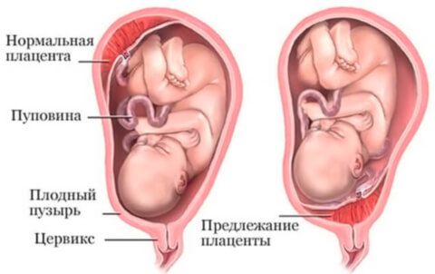 Причины предлежания плаценты при беременности 12