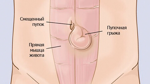 Пупочная грыжа