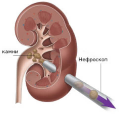 Удаление камней из почки нефроскопом