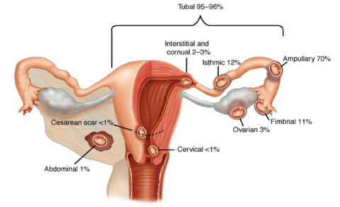 Места возникновения внематочной беременности
