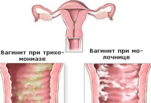 Воспаление влагалища