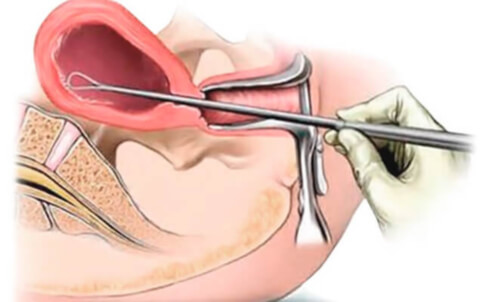 Выскабливание полости матки