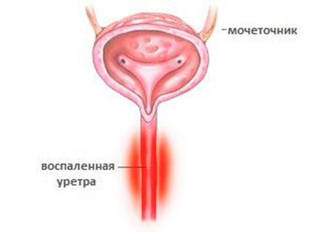 Выделения при уретрите Выделение гноя из уретры при уретрите