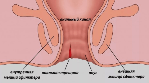 Анальные трещины