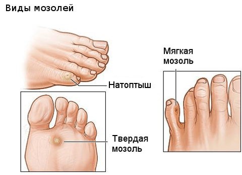 Утолщение кожи ноги мозоль thumbnail