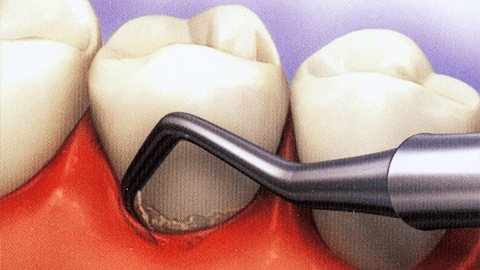 Лечение зубов ультразвуком