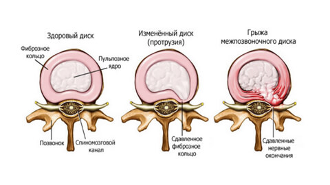 Лечение грыжи межпозвоночного диска