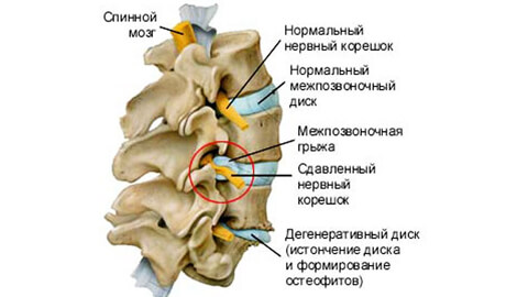 Лечение грыжи межпозвоночного диска