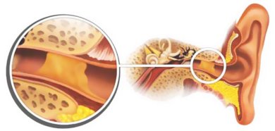 Серная пробка в ухе: показание к промыванию ушей
