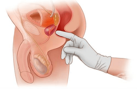 Массаж предстательной железы