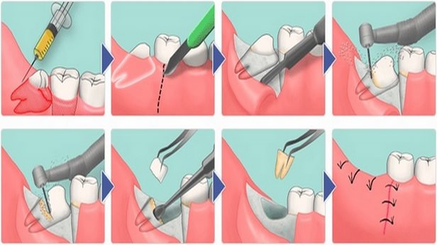 этапы удаления зуба