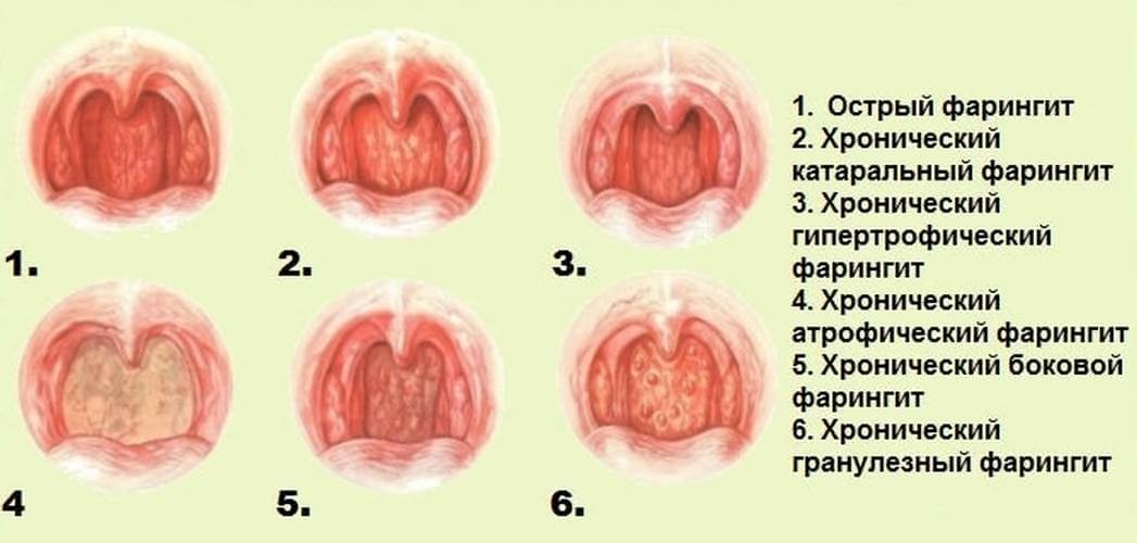 классификация фарингитов