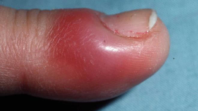 Отек палец на руке инфекция thumbnail