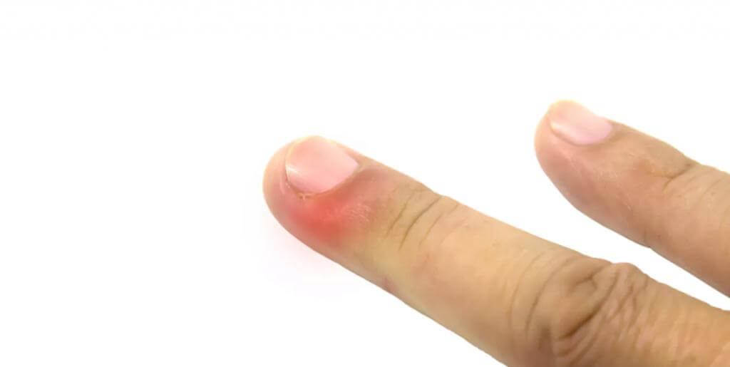 Опух палец внутри жидкость thumbnail
